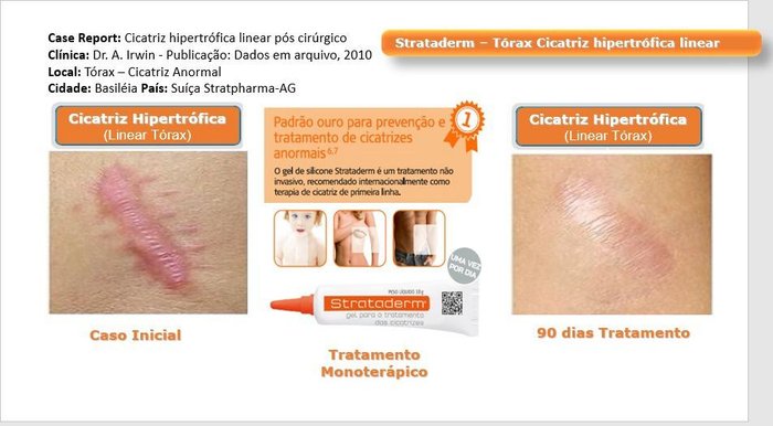 Cicatriz hipertrófica linear tratada com Strataderm