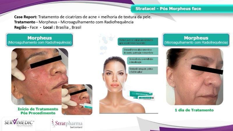 Stratacel pós Morpheus face
