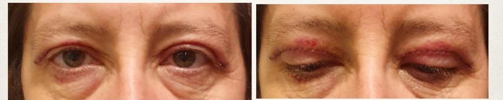 Evolução região palpebral operada