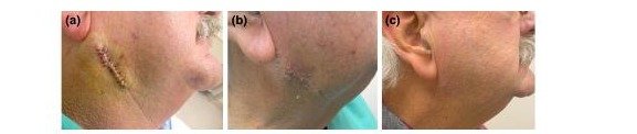 Caso Mohs tratado com gel de silicone