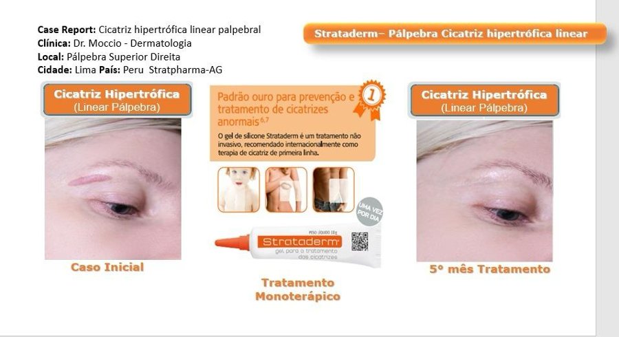 Strataderm cicatriz hipertrófica palpebral