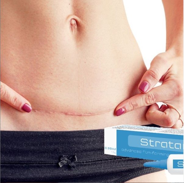 Stratamed — abdominoplastia