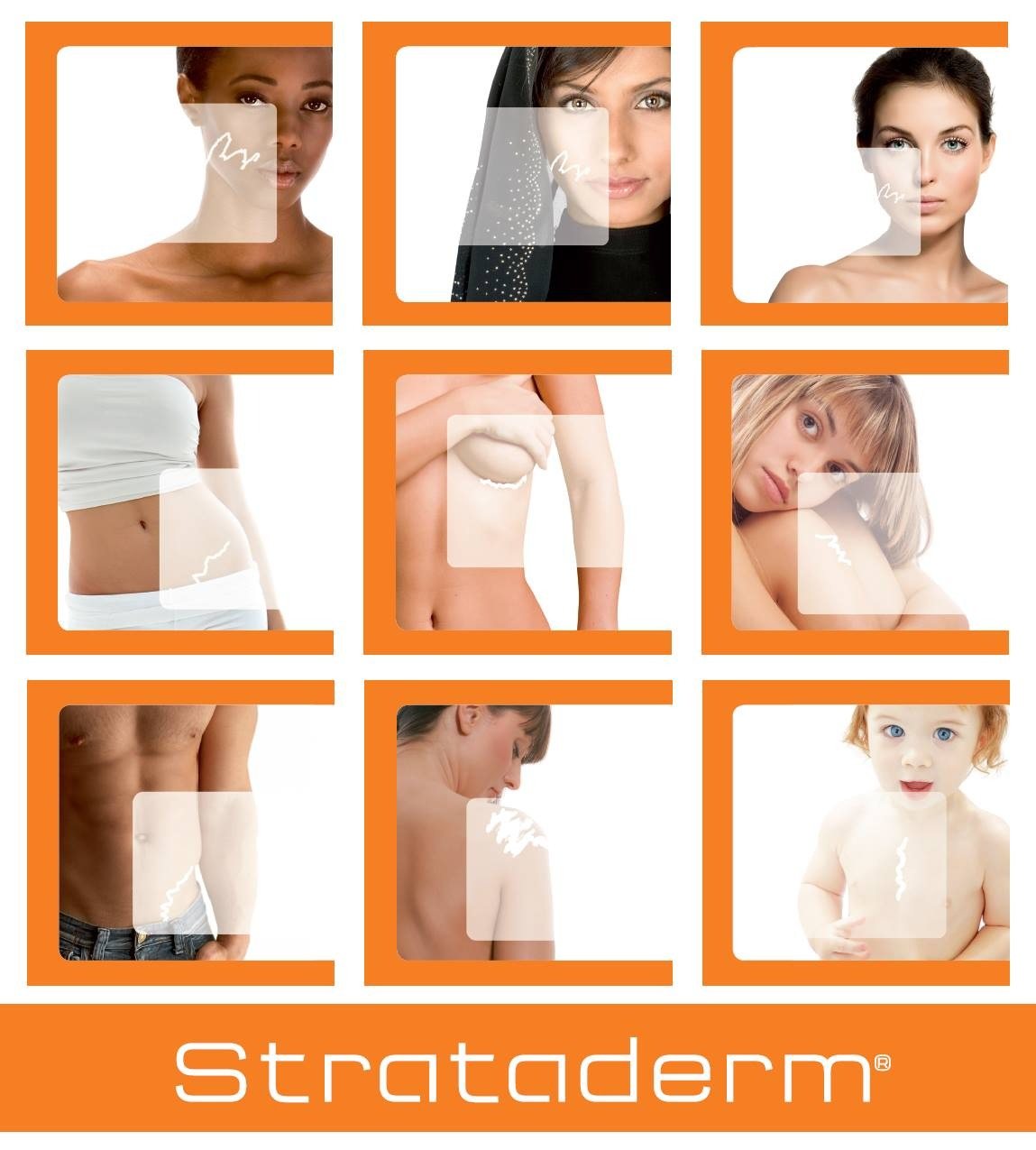 Strataderm — cicatrizes hipertróficas e queloidais e suas indicações. Fonte: mat