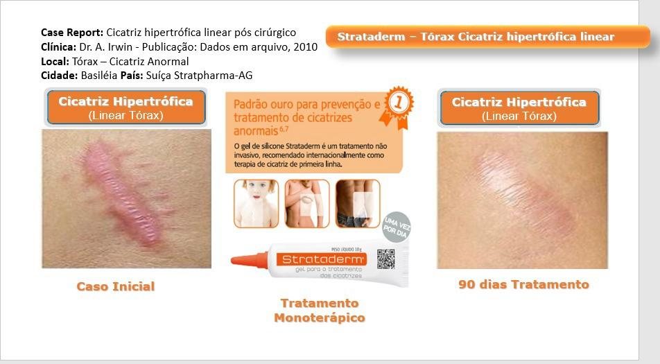 Strataderm — tórax, cicatriz hipertrófica linear