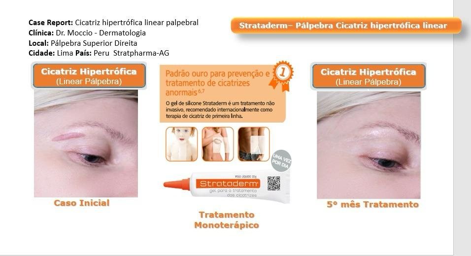 Strataderm — pálpebra, cicatriz hipertrófica linear