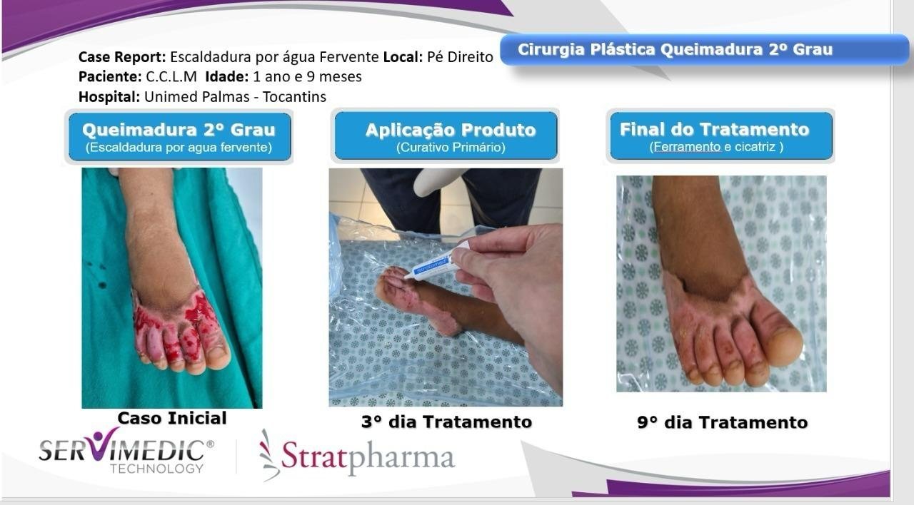 Stratamed — queimadura de 2º grau