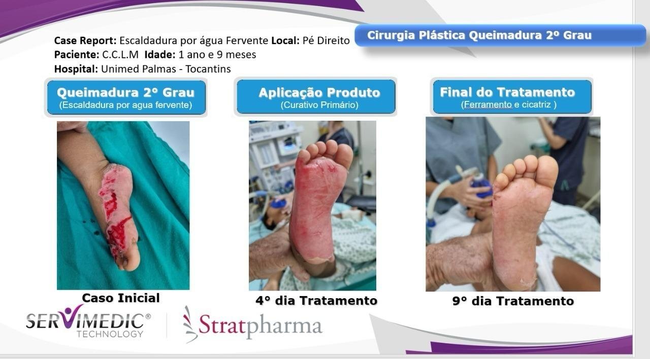 Stratamed — queimadura de 2º grau