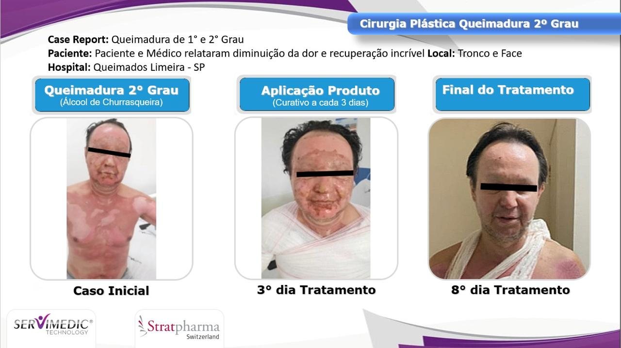 Stratamed — queimadura de 2º grau