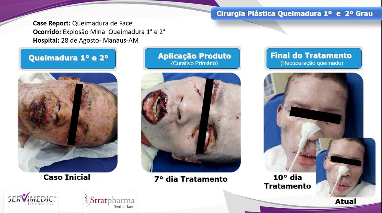 Stratamed — queimadura de 2º grau