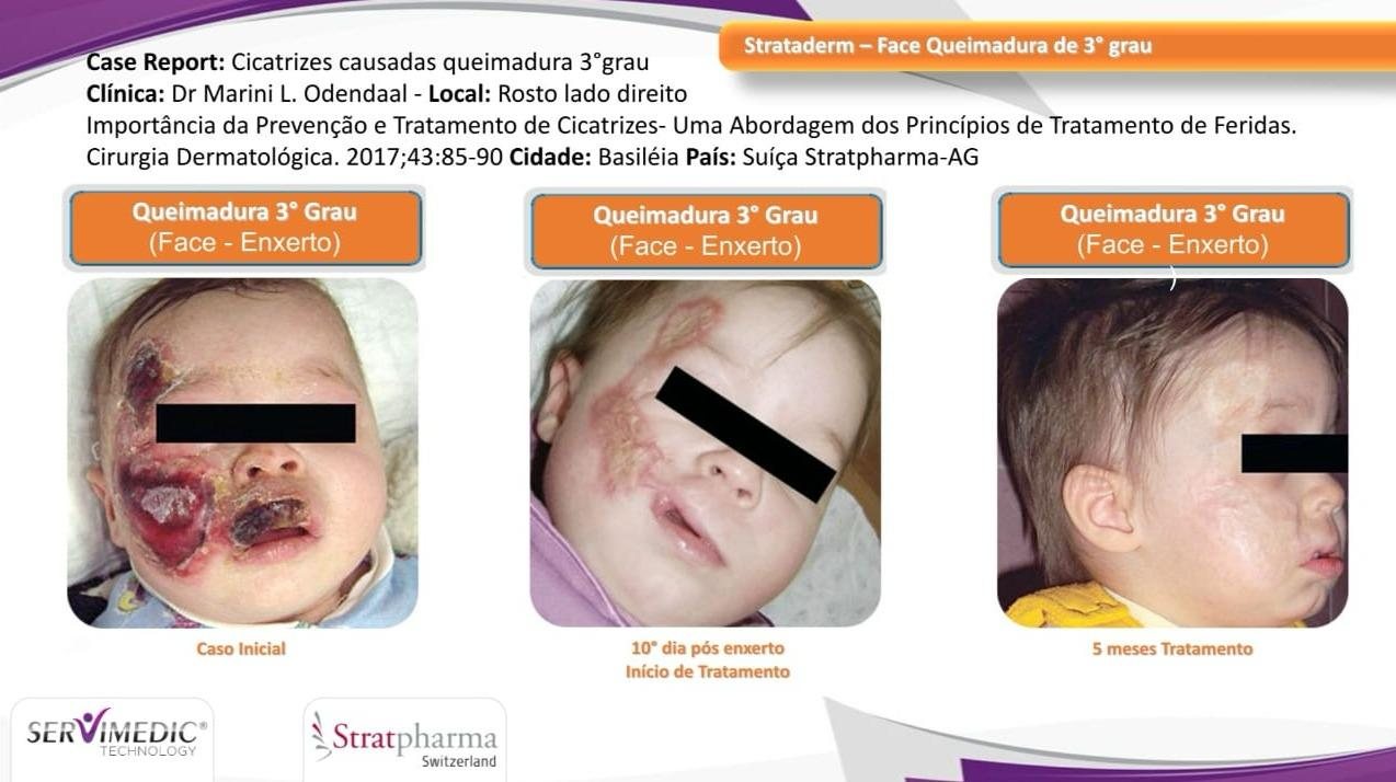 Strataderm — face, queimadura de 3º grau (fase de cicatriz). Fonte: registro do 