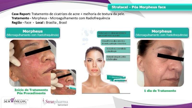 Stratacel após Morpheus (face). Fonte: registro do acervo (Estudo de Casos).