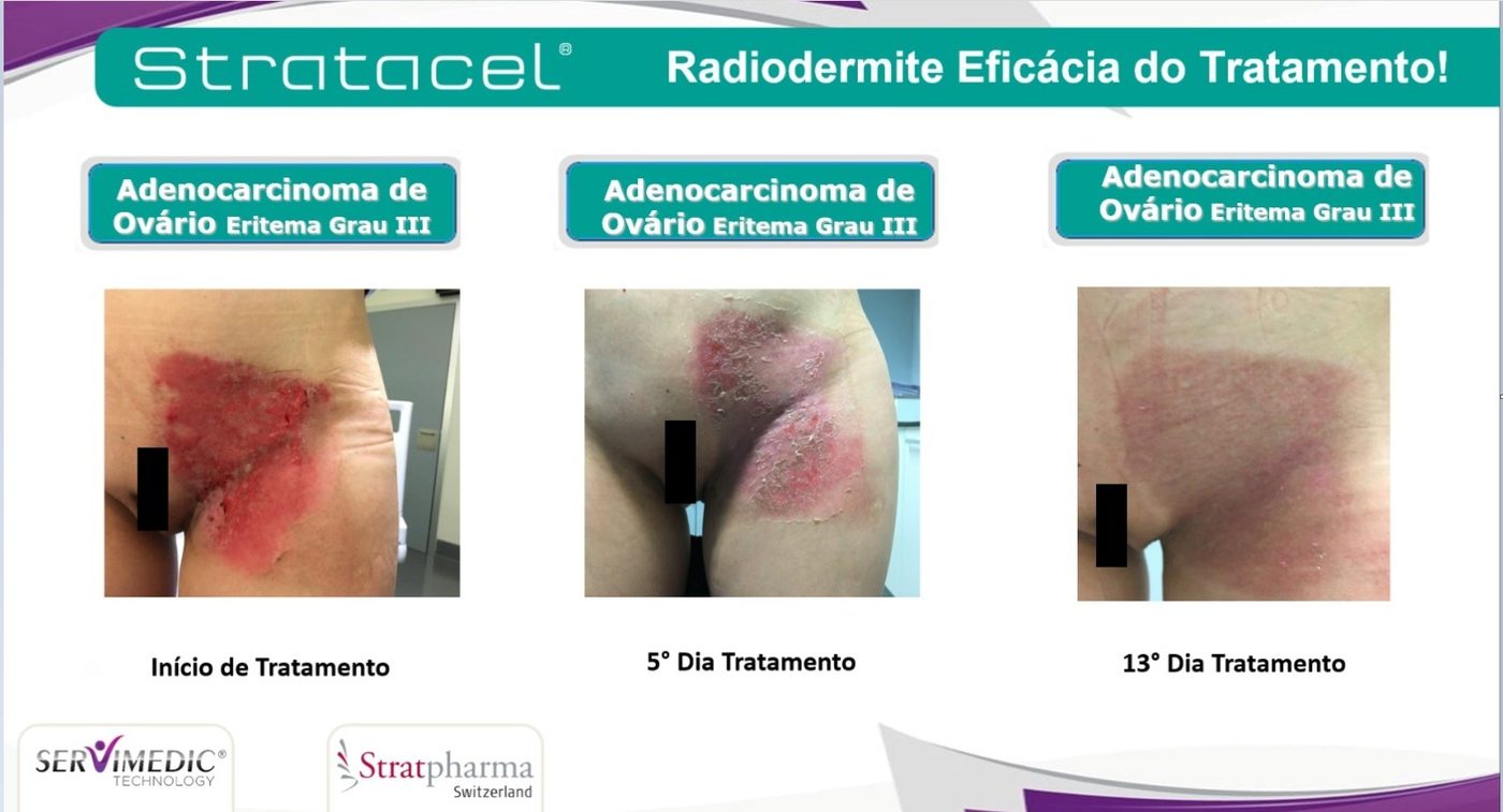 Radiodermite grau III em paciente com adenocarcinoma de ov&aacute;rio &mdash; evolu&ccedil;&atilde;o do in&iacute;cio ao 13&ordm; dia de tratamento com Stratacel
