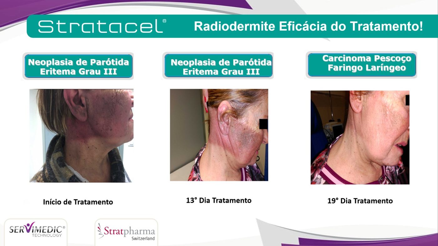 Radiodermite grau III em neoplasia de par&oacute;tida e carcinoma de pesco&ccedil;o, faringe e laringe &mdash; evolu&ccedil;&atilde;o at&eacute; o 19&ordm; dia com Stratacel