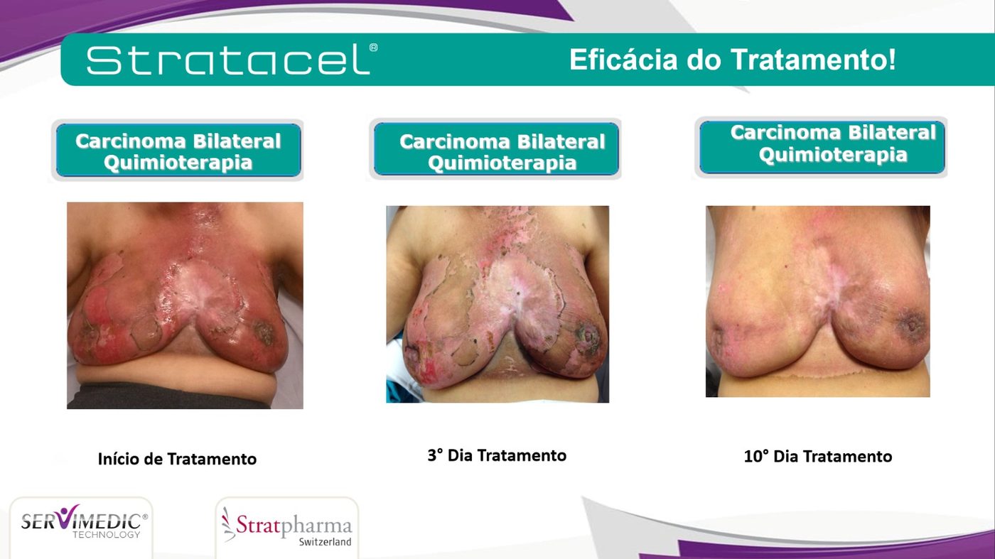 Les&atilde;o cut&acirc;nea extensa em paciente com carcinoma bilateral de mama em quimioterapia &mdash; evolu&ccedil;&atilde;o at&eacute; o 10&ordm; dia com Stratacel