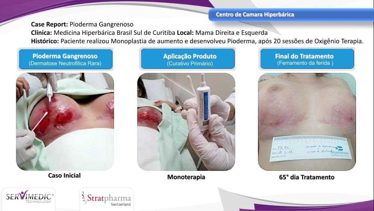 Stratamed — pioderma gangrenoso. Fonte: registro do acervo (Estudo de Casos).