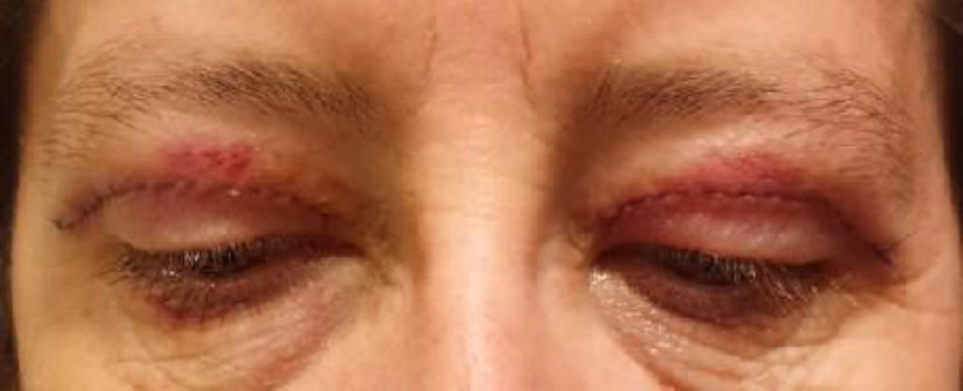 Pós-operatório imediato com edema palpebral