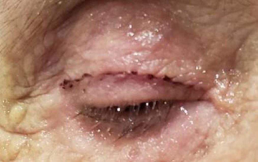 Incisão palpebral suturada, em detalhe