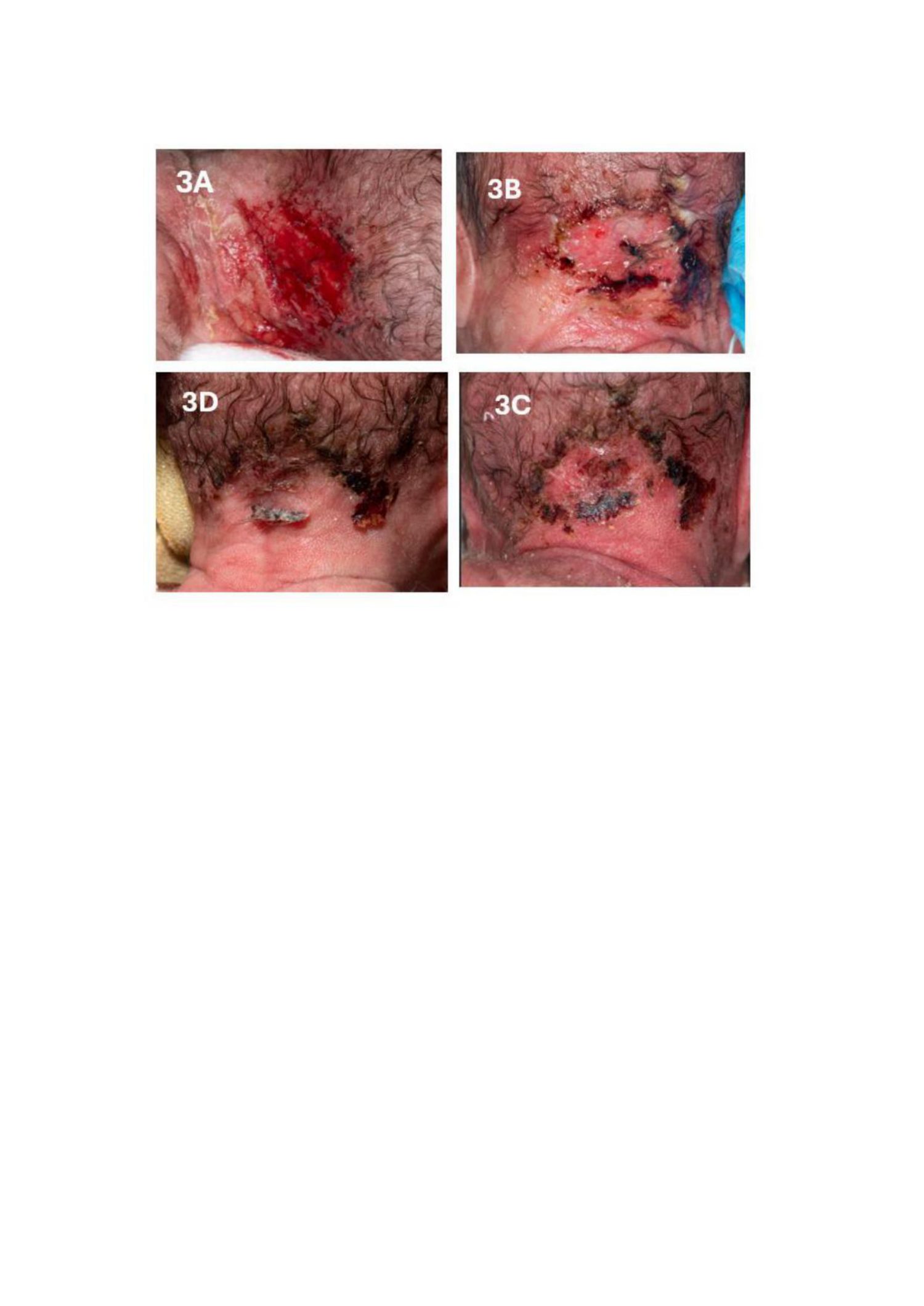 Caso 3 — prematura de 24 semanas e 6 dias, 496 g: lesão por pressão no occipúcio