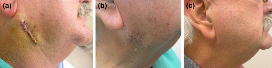 Paciente de 66 anos tratado com o curativo de gel de silicone: (a) imediatamente